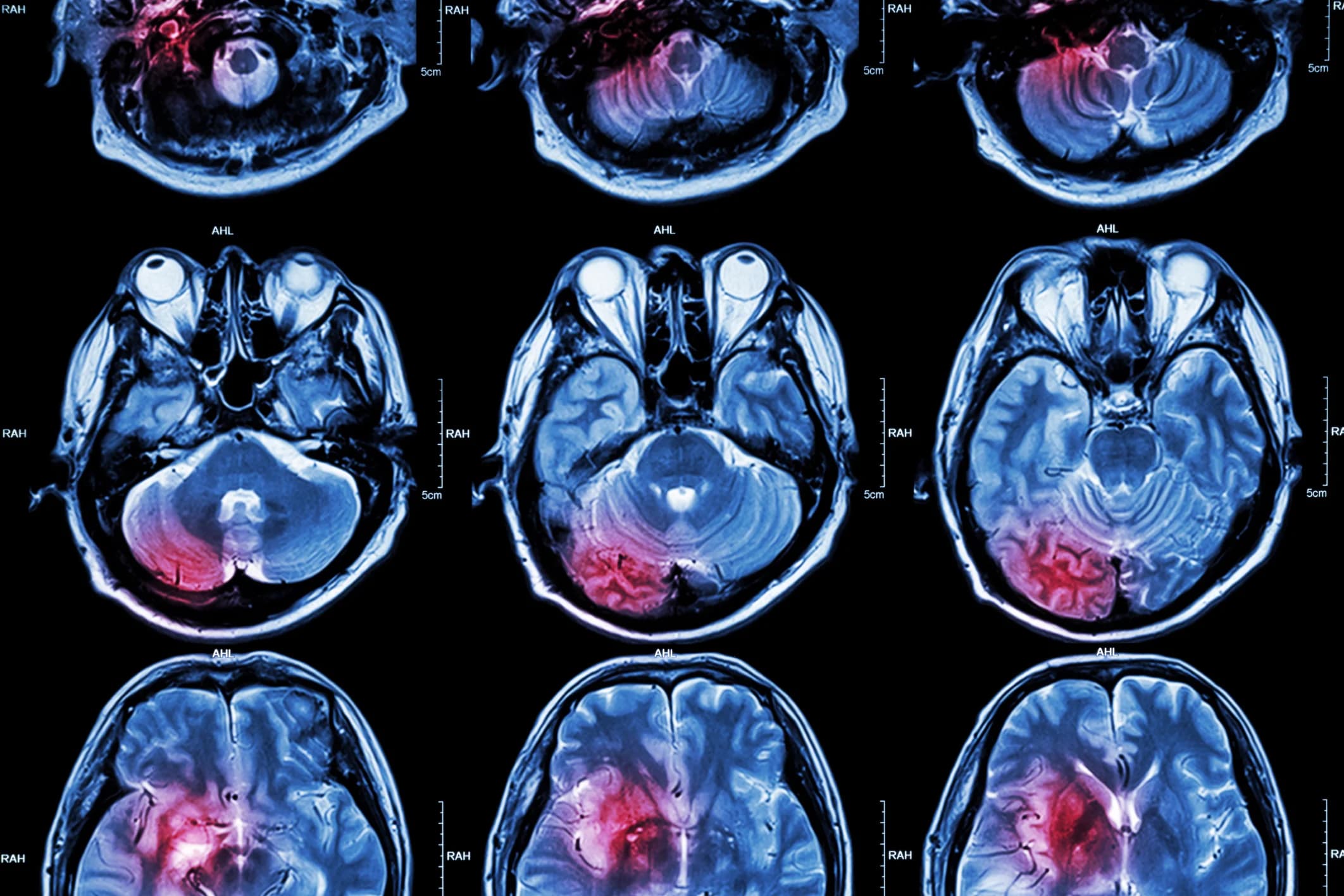 Concealed in the Back of the Brain: Strokes