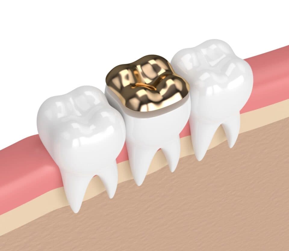 Sealing The Problems: The Role of Sealants in Preventive Dentistry