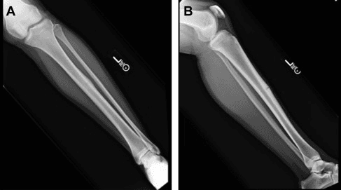 Tibial Stress Fractures in Athletes